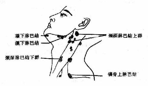 淋巴水肿最新疗法,淋巴水肿最新疗法的奇妙之旅