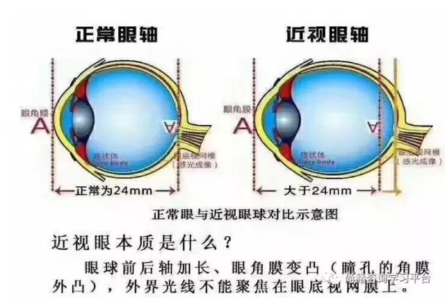 近视治疗